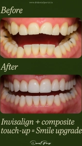 Composite Veneers