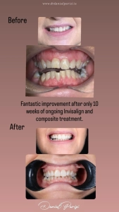 Composite Veneers