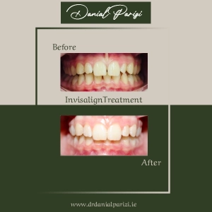 Invisalign Treatment
