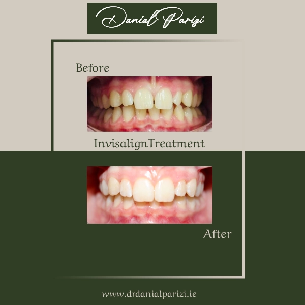 Invisalign Treatment