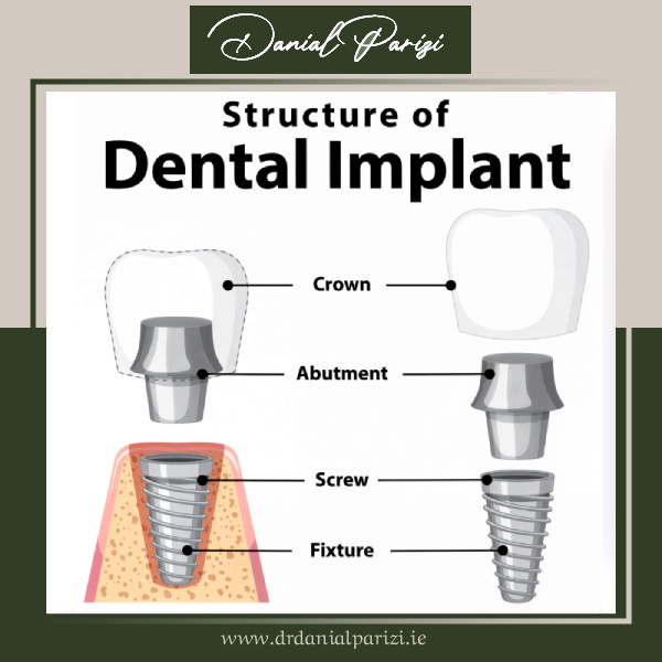 Parts of a Dental Implant