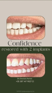 Dental implants before and after