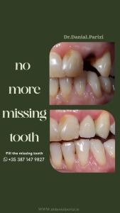 Dental implants before and after