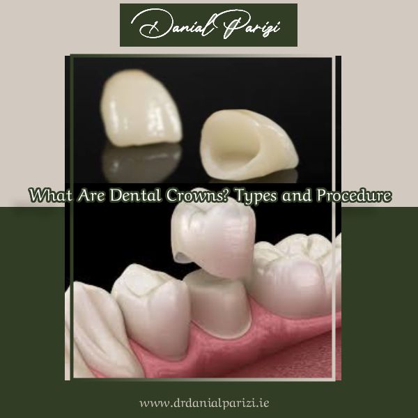 What Are Dental Crowns? Types and Procedure