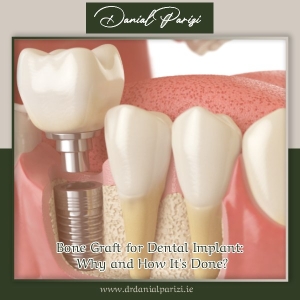 Bone Graft for Dental Implant: Why and How It's Done?