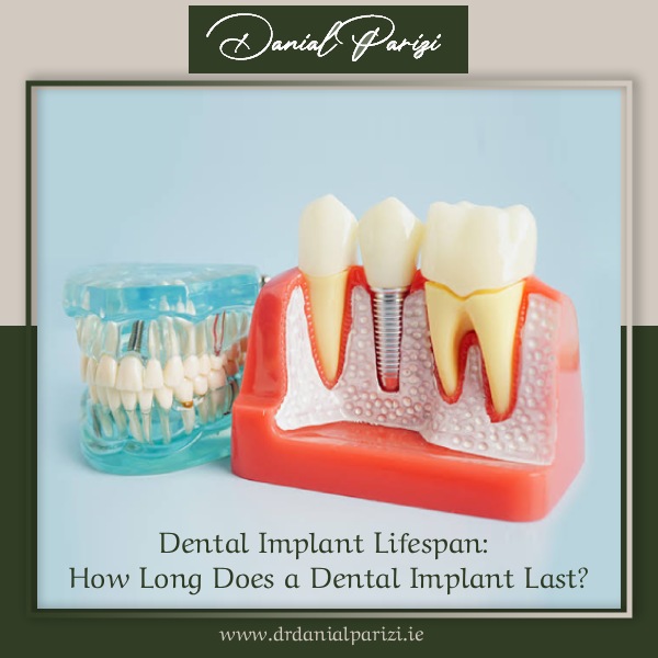 Dental Implant Lifespan: How Long Does a Dental Implant Last?