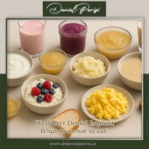 Diet After Dental Implant: What to or not to eat?